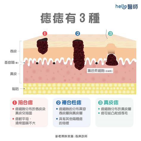 身體長黑痣|為什麼臉上的痣越來越多？皮膚科醫師解析長痣原因、。